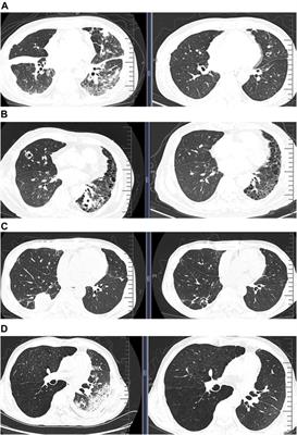 Metagenomic Next-Generation Sequencing for Diagnosing Infections in Lung Transplant Recipients: A Retrospective Study